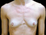 Patient # 39698 Before Photo # 1
